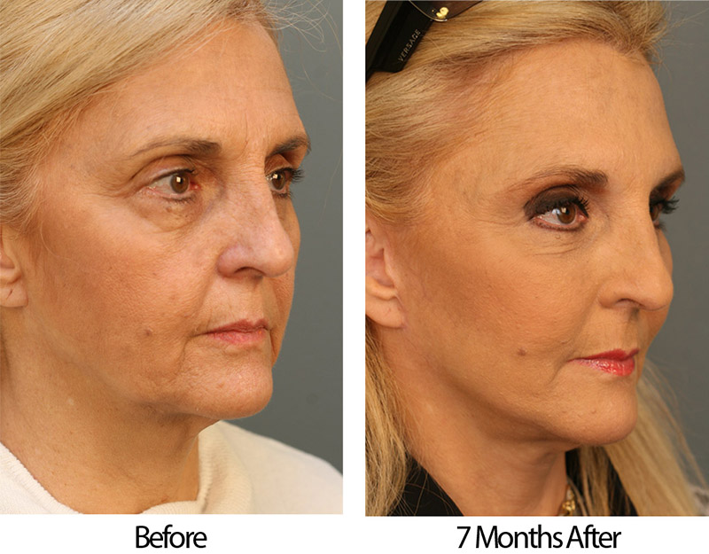 Estella BeforeAfter Right Angle Patient 47