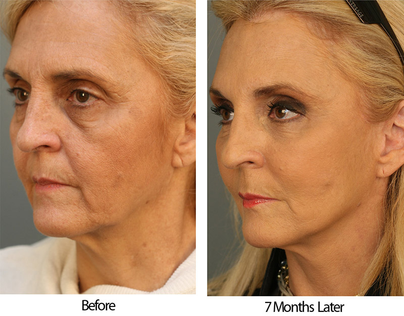 Estella BeforeAfter Left Angle Patient 47