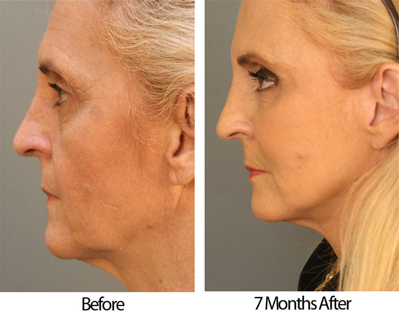 Estella BeforeAfter Left Side Patient 47