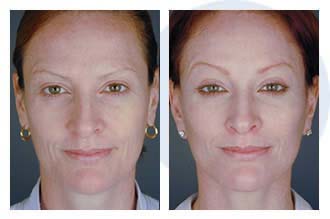 Extreme Makeover$21a Patient 21