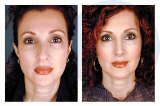 Patient 22 Extreme Makeover$23a Patient 22