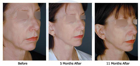 Patient 24 Extreme Makeover$25b Patient 24