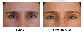 Patient 53 eye$53b Patient 53