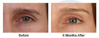 Patient 53 eye$53d Patient 53
