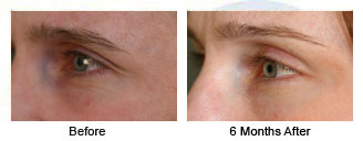 Patient 53 eye$53f Patient 53