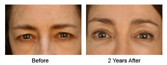 Patient 57 eye$57b Patient 57