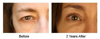Patient 57 eye$57c Patient 57