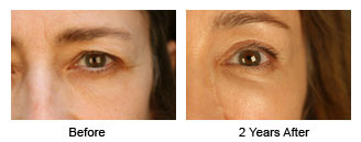 Patient 57 eye$57d Patient 57