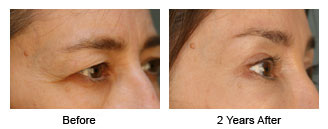Patient 57 eye$57e Patient 57