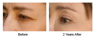 Patient 57 eye$57f Patient 57