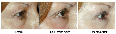 Patient 27 eyelift$27C Patient 27