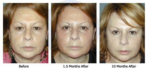 Patient 27 eyelift$27a Patient 27