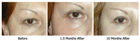 Patient 27 eyelift$27b Patient 27