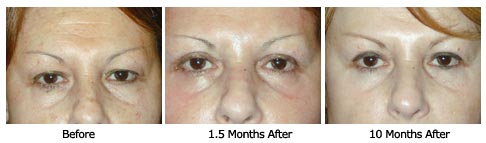 Patient 27 eyelift$27d Patient 27