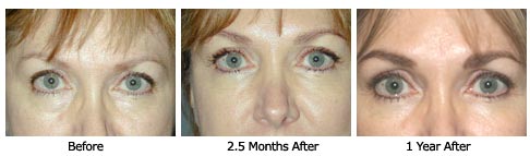 Patient 31 eyelift$30a Patient 31