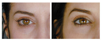 Patient 32 eyelift$31c Patient 32