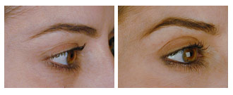 eyelift$31d Patient 32