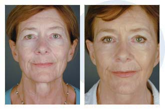 Patient 35 eyelift$35a Patient 35