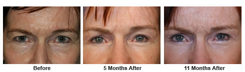 eyelift$46a Patient 46