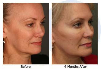 Patient 32 facelift$33b Patient 32