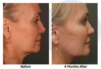 Patient 32 facelift$33c Patient 32