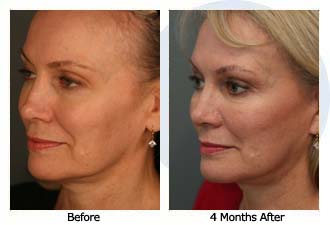 Patient 32 facelift$33d Patient 32