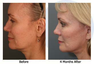 facelift$33e Patient 32