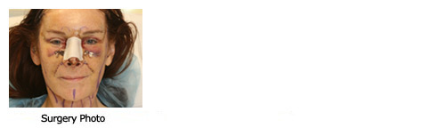 facelift$35f Patient 34