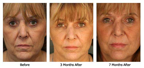 Patient 35 make$140ab Patient 35