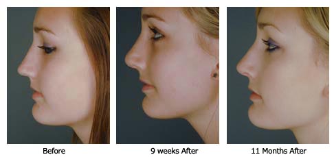 rhino$56c Patient 56