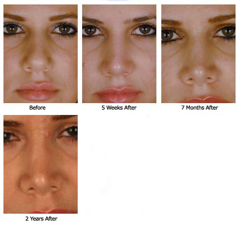 Patient 61 rhino$60f new Patient 61