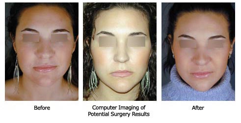 Patient 63 rhino$63composite Patient 63