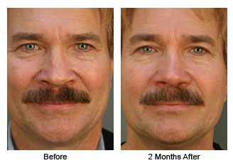 rhino 203a Patient 198