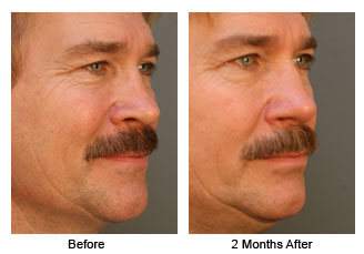 rhino 203c Patient 198