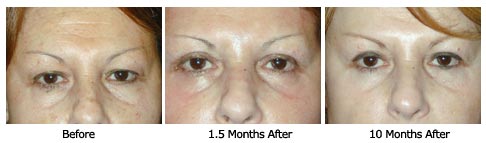 eyelift$27d Patient 27