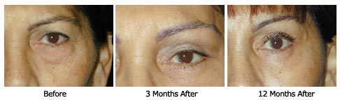 eyelift$29d Patient 29