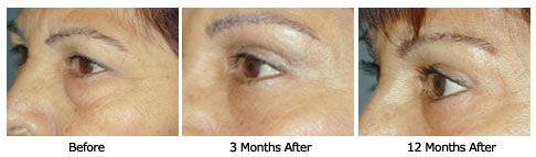 eyelift$29e Patient 29