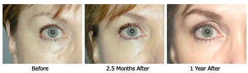 eyelift$30b Patient 31