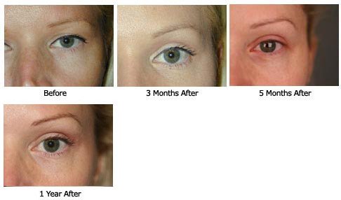 eyelift$33d Patient 33