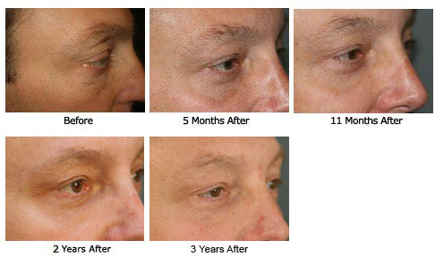 eyelift$38d Patient 38