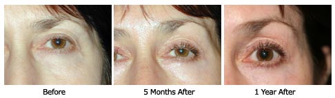 eyelift$39d Patient 39