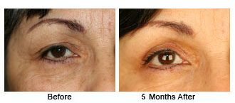 eyelift$45d Patient 45