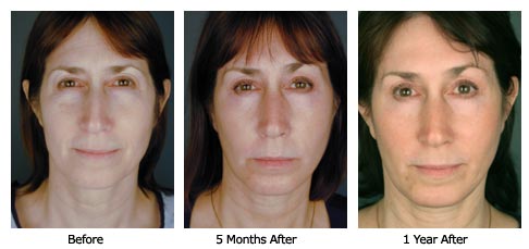 facelift$32a Patient 31