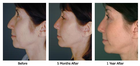 facelift$32c Patient 31