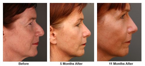 facelift$35c Patient 34