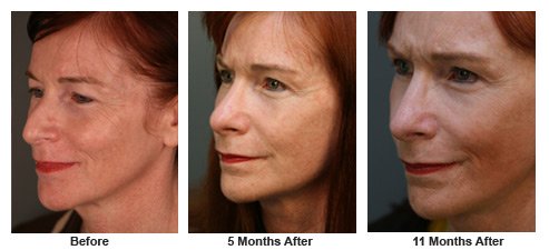 facelift$35d Patient 34