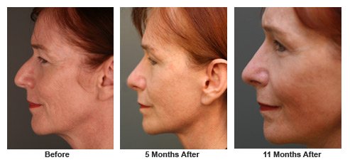 facelift$35e Patient 34