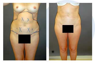 liposuction$22 Patient 22