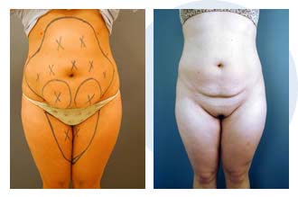 liposuction$29a Patient 29