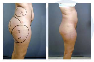 liposuction$32 Patient 32